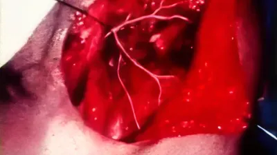 Procedimiento quirúrgico de tumor de glándula parótida