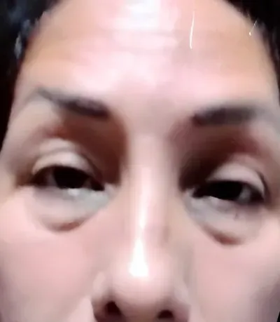 Fotografía clínica inicial (Antes) de blefaroplastia