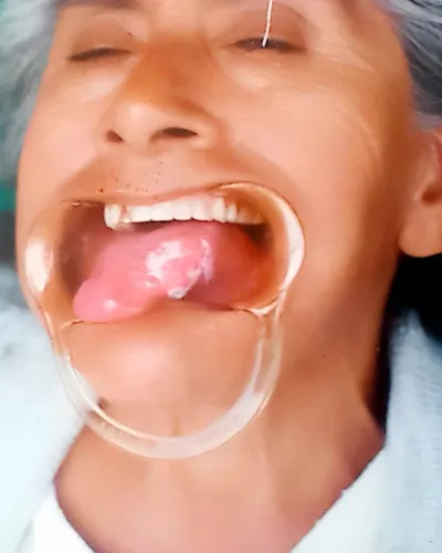 Fotografía clínica de lesión tumoral de cáncer de lengua en cavidad oral