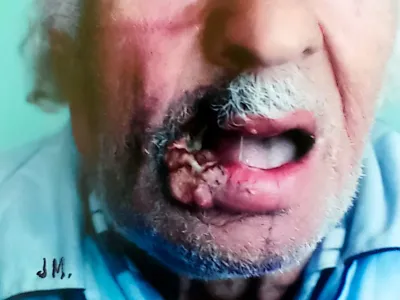 Fotografía clínica de cáncer de labio inferior