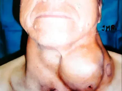 Fotografía clínica de cáncer metastásico en región de tiroides