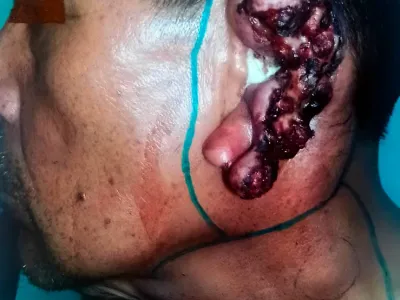 Fotografía clínica de cáncer de pabellón auricular