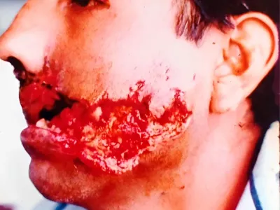 Fotografía clínica preoperatoria de traumatismo maxilofacial caso 01