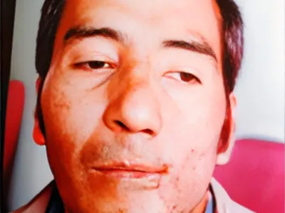 Fotografía clínica posoperatoria de traumatismo maxilofacial caso 01