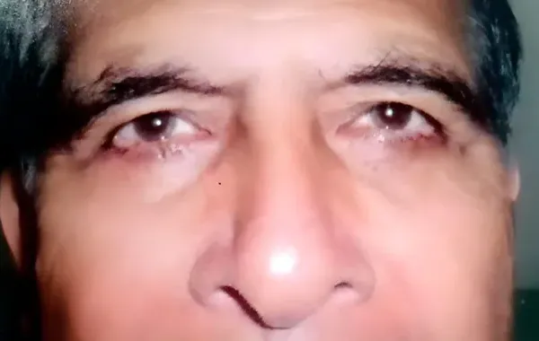 Fotografía clínica posoperatoria de rinoplastia y blefaroplastia caso 02