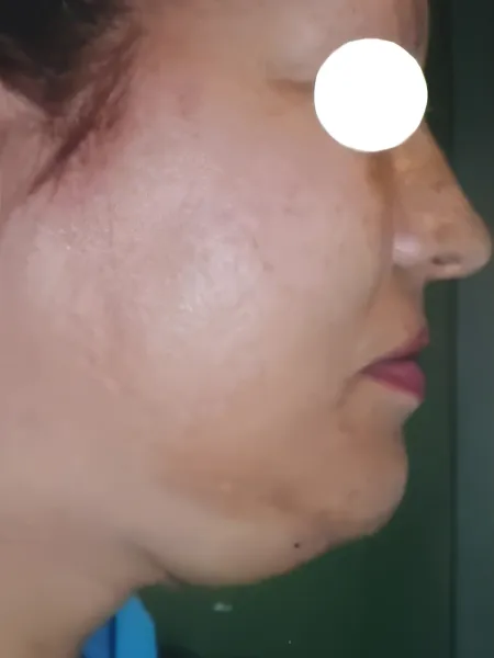 Fotografía clínica inicial (Antes) de liposupresión y contorno cervicofacial submentoniano