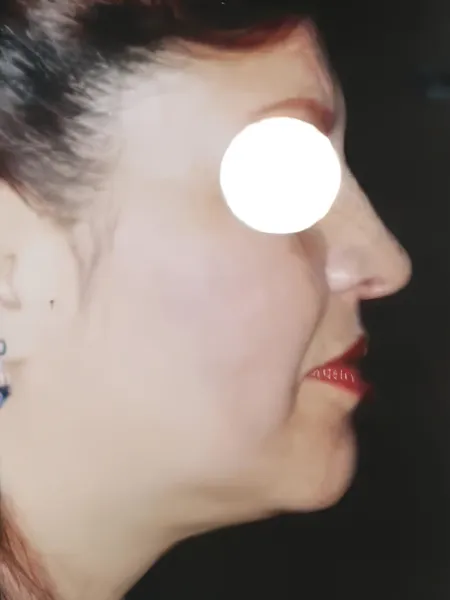 Fotografía clínica posoperatoria (Después) de liposupresión y contorno cervicofacial submentoniano