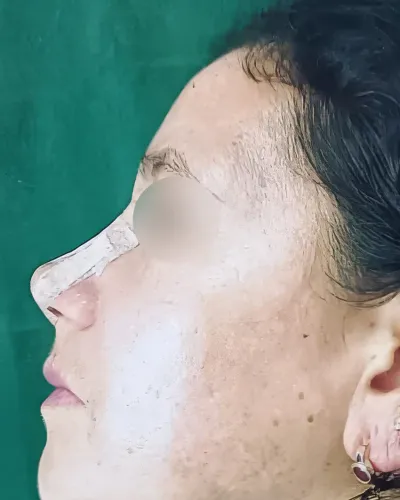 Fotografía clínica posoperatoria (Después - Vista 1) de rinoplastia estética y funcional