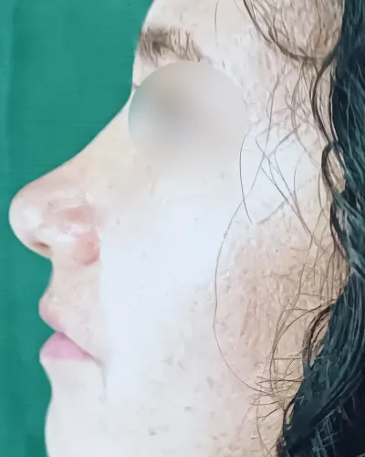 Fotografía clínica posoperatoria (Después - Vista 2) de rinoplastia estética y funcional