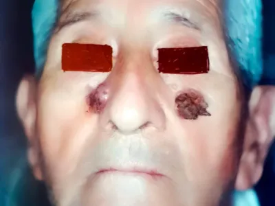 Fotografía clínica de melanoma maligno de piel