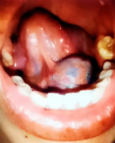 Fotografía clínica de ránula en la cavidad oral