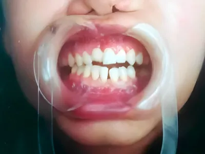 Fotografía clínica de atención en trauma bimaxilar